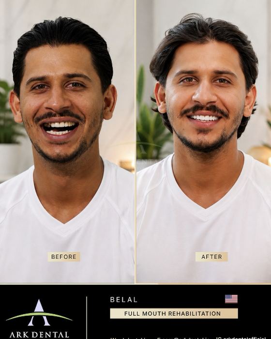 Belal from the USA: full mouth rehabilitation